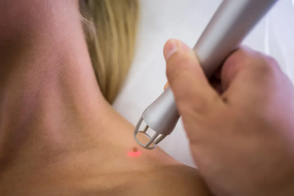 Skin Tag Removal